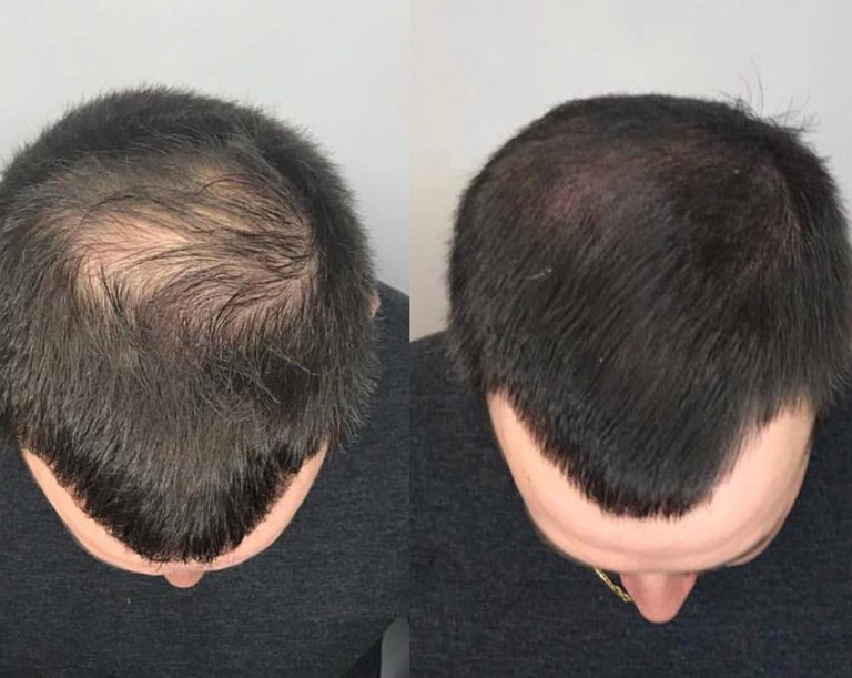 Advanced SMP: Scalp & Beard Micro Pigmentation Guide